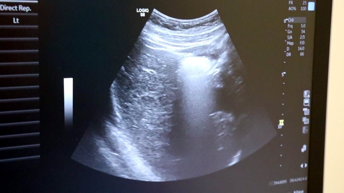 4 boyutlu ultrason ile bebeğin hastalıkları doğmadan anlaşılıp tedavi edilebiliyor

