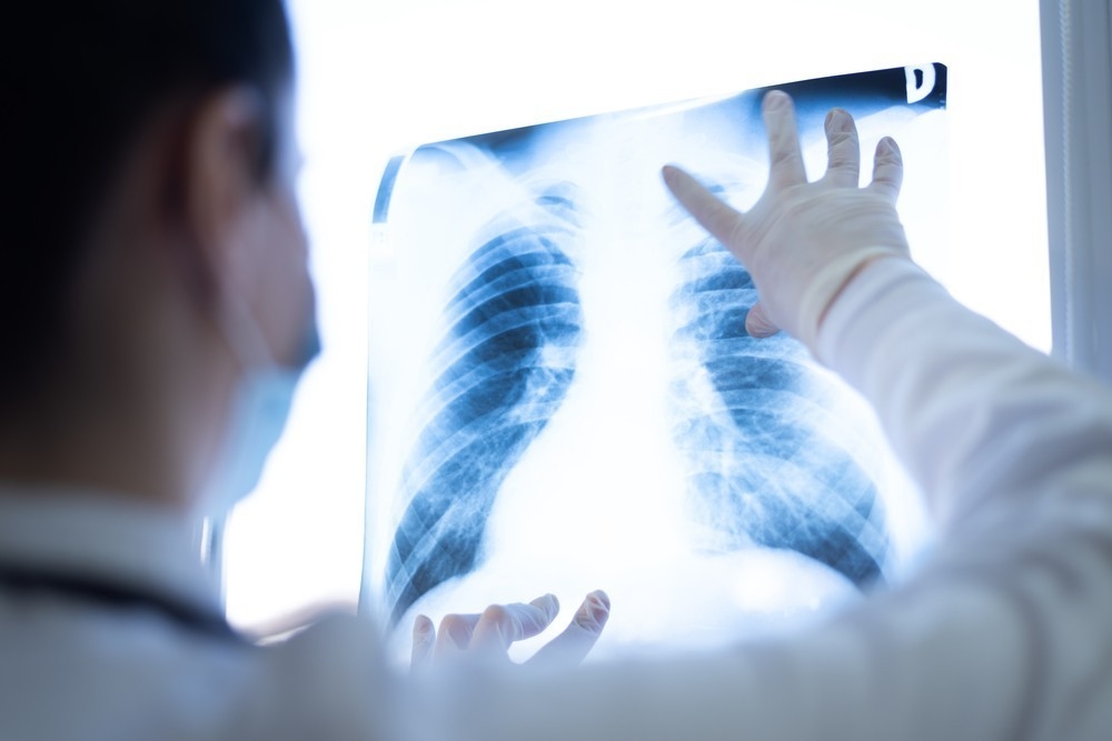 “Ciğerlerde kalan Covid-19 nodülleri akciğer kanseri başlangıcı olabilir”
