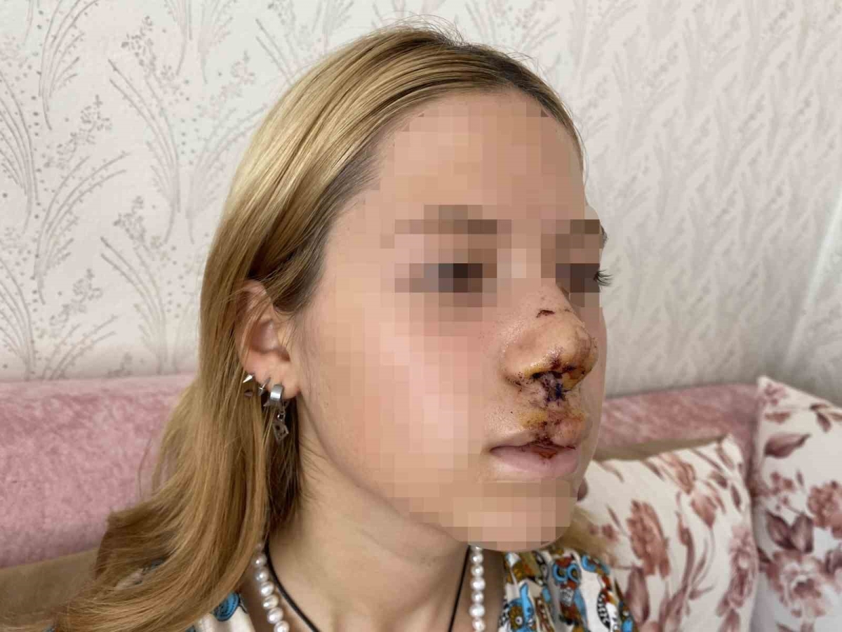 Lise öğrencisi kızın suratına attığı taşla dişlerinin kırılmasına neden olan gencin yargılanmasına başlanıldı
